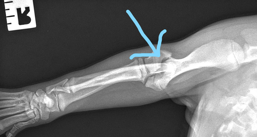 X Ray showing the Condylar Humeral Fracture